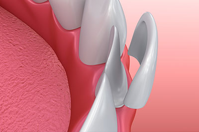 Cosmetic Dental Veneers 27403