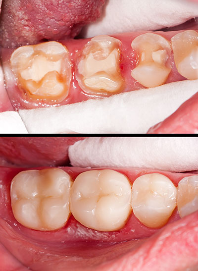 Kraska Center for Cosmetic and General Dentistry | Dental Cleanings, Implant Restorations and Ceramic Crowns
